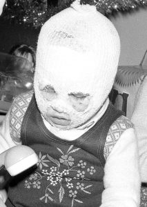 Bambina di Seveso sfigurata dopo l'esplosione